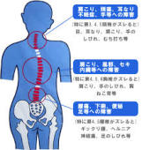 背骨の歪み　姿勢矯正